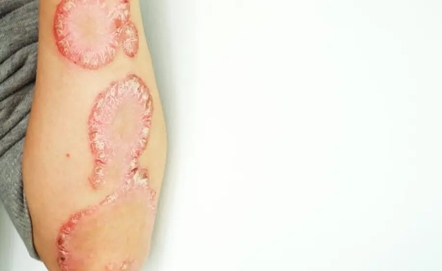 Psoriasi: che cos'è e rimedi naturali per curarla