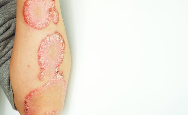 Psoriasi: che cos'è e rimedi naturali per curarla