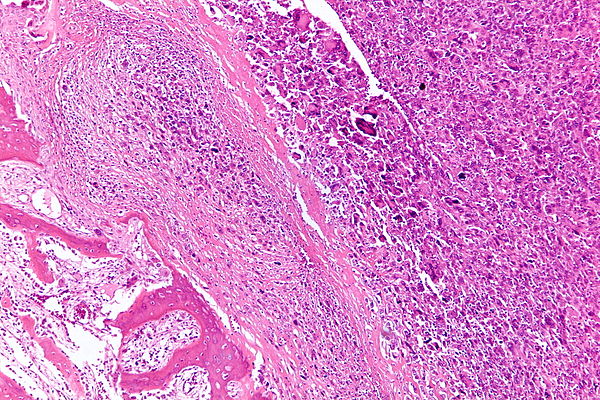 L'Osteosarcoma